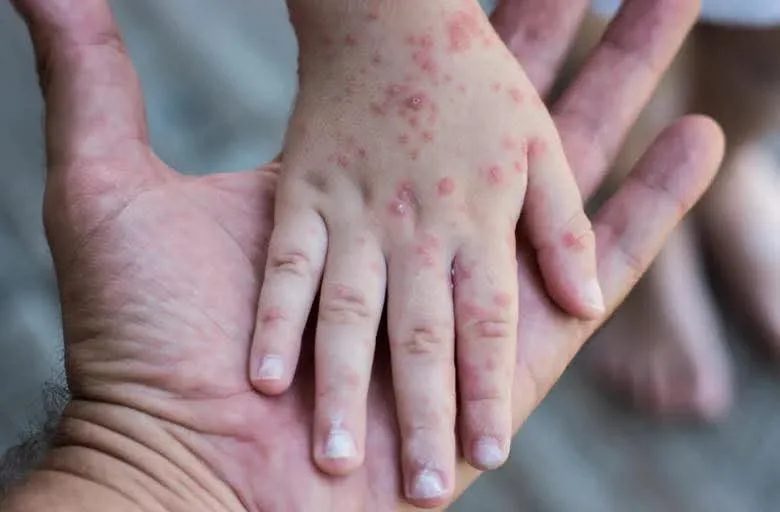 Aumentan casos de sarampión en Tamaulipas